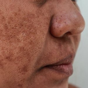hyperpigmentation_melasma_1024x1024 hyperpigmentation_melasma_1024x1024